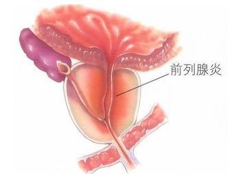 前列腺炎患者应该如何坐浴